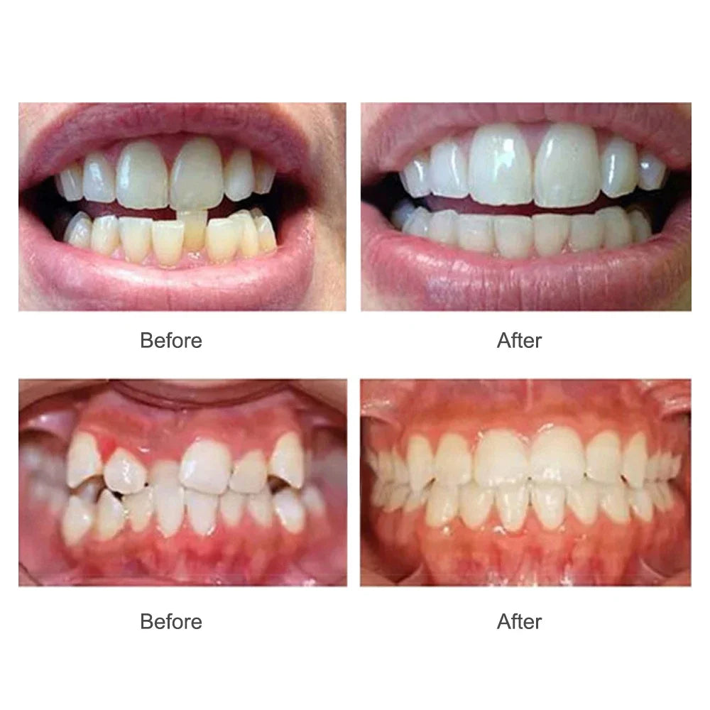 Teeth Alignment & Jawline Mouth Retainer